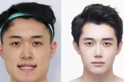 男性整形美容,塑造自信新形象的秘密武器