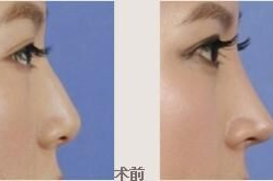 假体隆鼻整形费用多少钱,费用构成与影响因素全解析