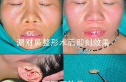 鼻孔整形手术,揭秘鼻孔整形手术的奥秘与效果
