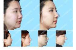 硅胶隆鼻整形手术,安全塑美，重塑自然鼻型之美
